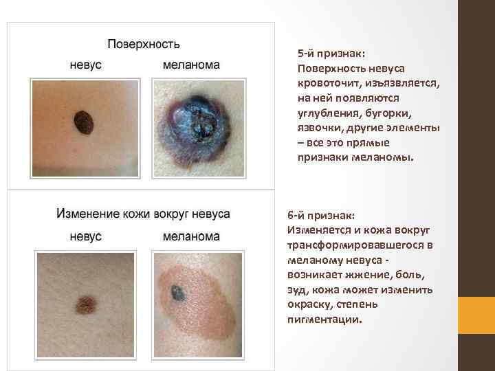 5 й признак: Поверхность невуса кровоточит, изъязвляется, на ней появляются углубления, бугорки, язвочки, другие