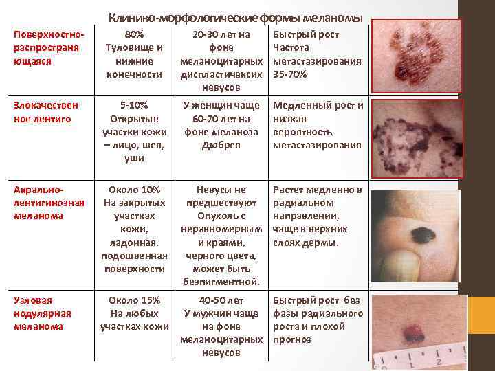 Клинико морфологические формы меланомы Поверхностно распространя ющаяся 80% Туловище и нижние конечности 20 30