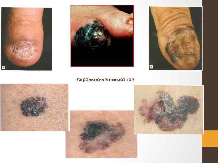 Акрально лентигиозное 