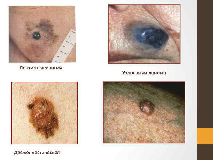 Лентиго меланома Десмопластическая Узловая меланома 