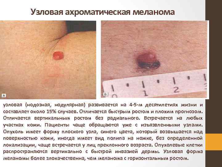 Узловая ахроматическая меланома узловая (нодозная, нодулярная) развивается на 4 5 м десятилетиях жизни и