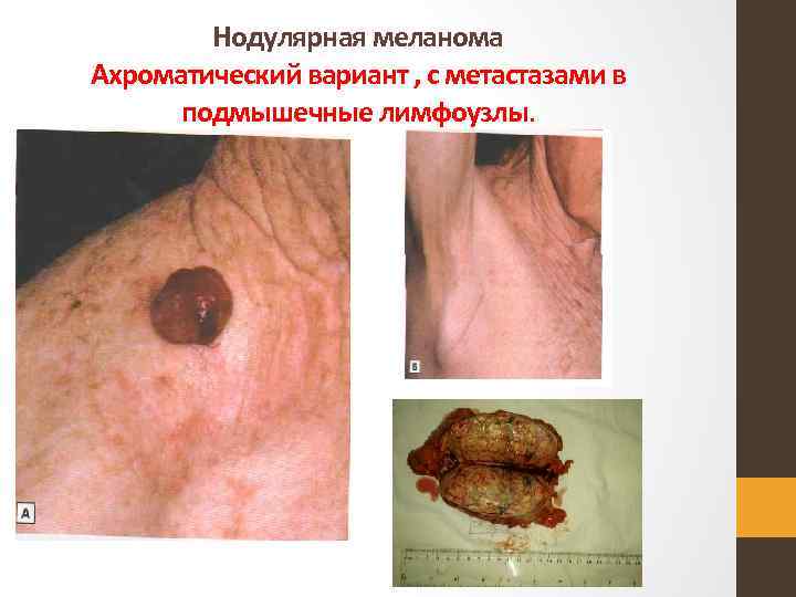 Нодулярная меланома Ахроматический вариант , с метастазами в подмышечные лимфоузлы. 