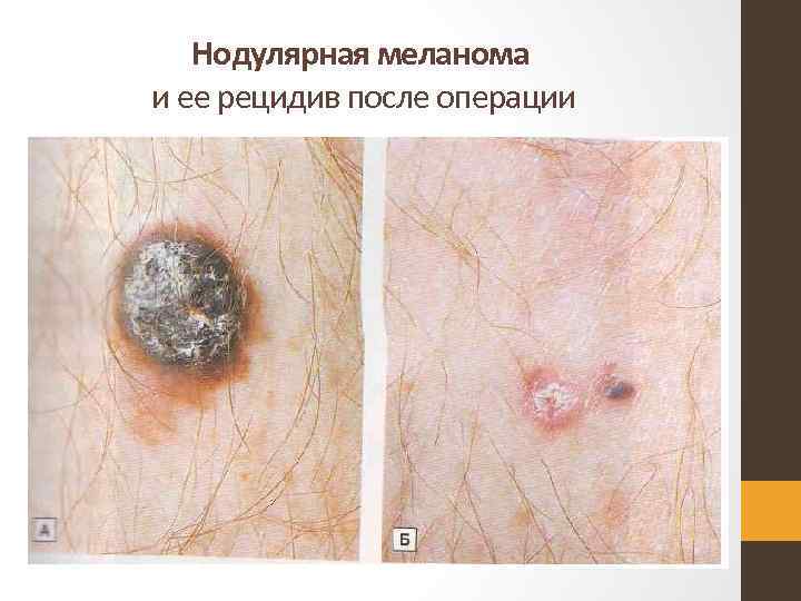 Нодулярная меланома и ее рецидив после операции 