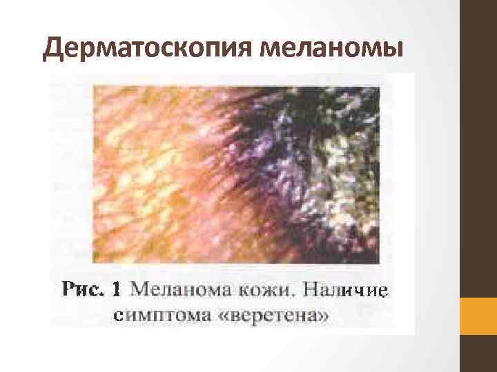 Дерматоскопия меланомы 