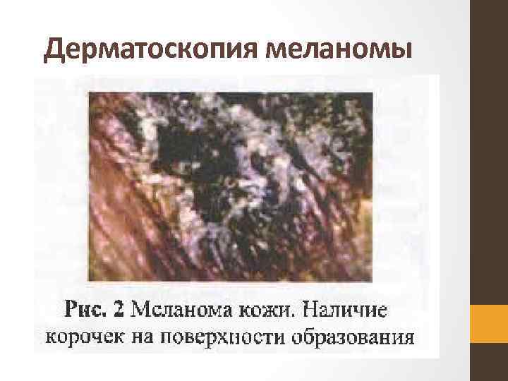 Дерматоскопия меланомы 