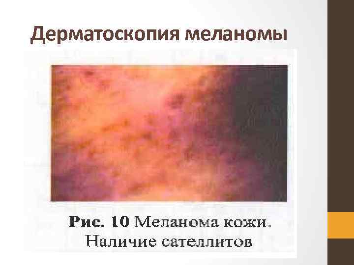 Дерматоскопия меланомы 