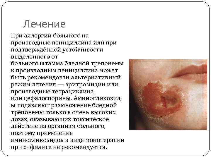 Лечение При аллергии больного на производные пенициллина или при подтверждённой устойчивости выделенного от больного