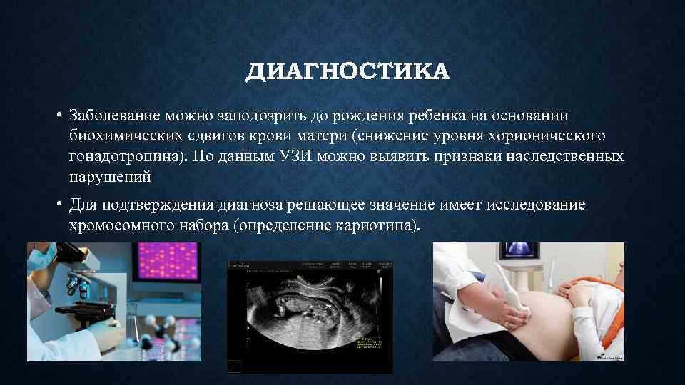ДИАГНОСТИКА • Заболевание можно заподозрить до рождения ребенка на основании биохимических сдвигов крови матери