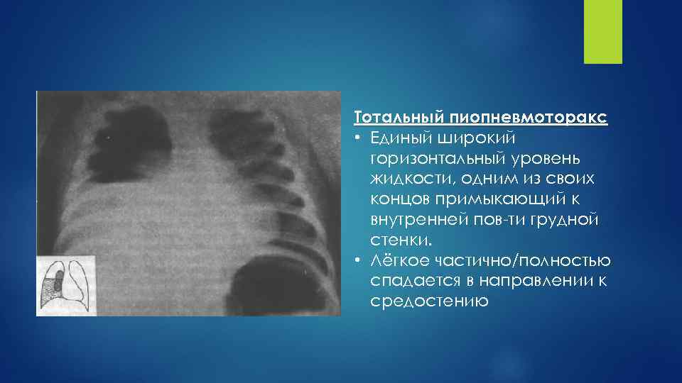 Тотальный пиопневмоторакс • Единый широкий горизонтальный уровень жидкости, одним из своих концов примыкающий к