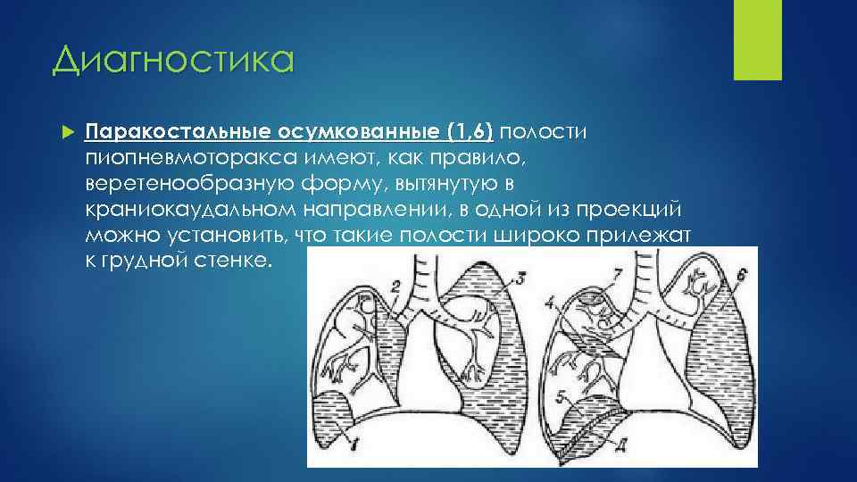 Диагностика Паракостальные осумкованные (1, 6) полости пиопневмоторакса имеют, как правило, веретенообразную форму, вытянутую в