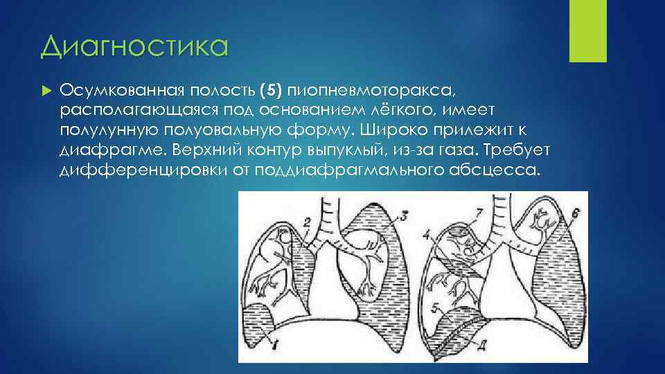 Диагностика Осумкованная полость (5) пиопневмоторакса, располагающаяся под основанием лёгкого, имеет полулунную полуовальную форму. Широко