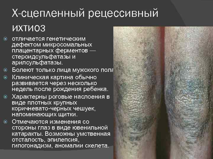 Х-сцепленный рецессивный ихтиоз отличается генетическим дефектом микросомальных плацентарных ферментов — стероидсульфатазы и арилсульфатазы. Болеют