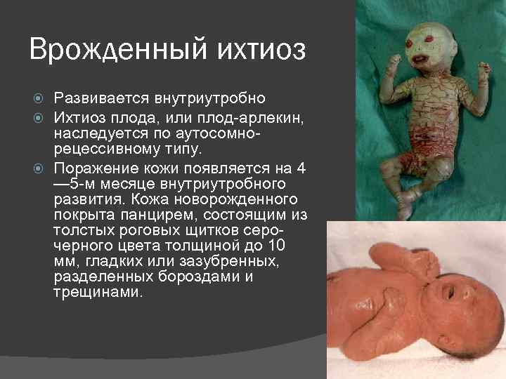 Врожденный ихтиоз Развивается внутриутробно Ихтиоз плода, или плод-арлекин, наследуется по аутосомнорецессивному типу. Поражение кожи
