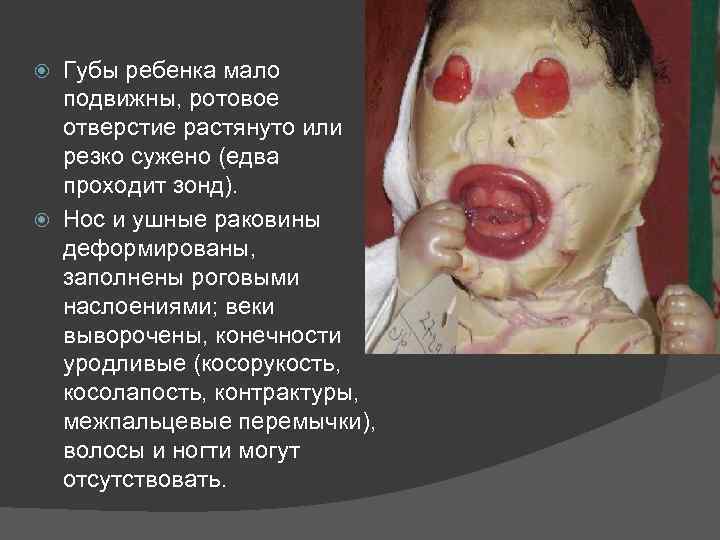 Губы ребенка мало подвижны, ротовое отверстие растянуто или резко сужено (едва проходит зонд). Нос