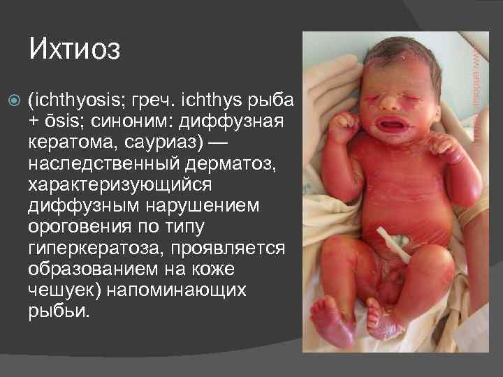 Ихтиоз (ichthyosis; греч. ichthys рыба + ōsis; синоним: диффузная кератома, сауриаз) — наследственный дерматоз,