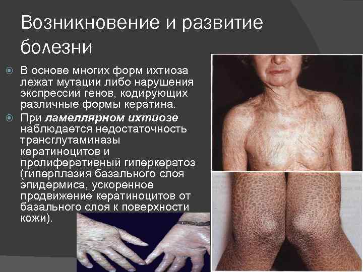 Возникновение и развитие болезни В основе многих форм ихтиоза лежат мутации либо нарушения экспрессии
