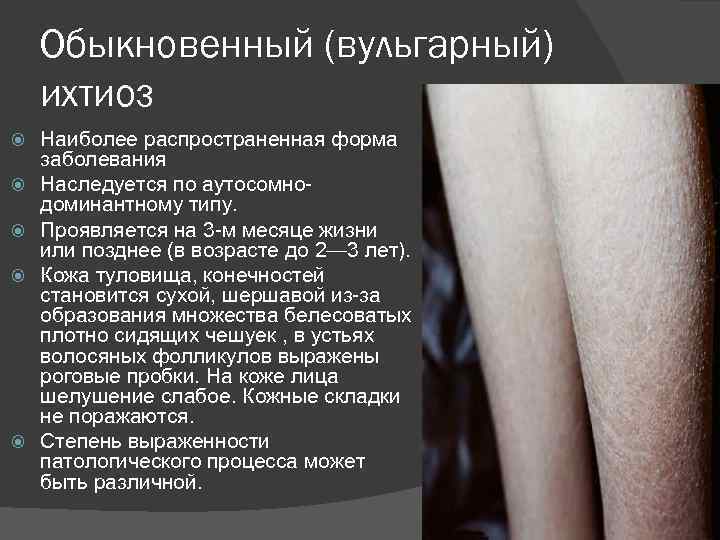 Обыкновенный (вульгарный) ихтиоз Наиболее распространенная форма заболевания Наследуется по аутосомнодоминантному типу. Проявляется на 3