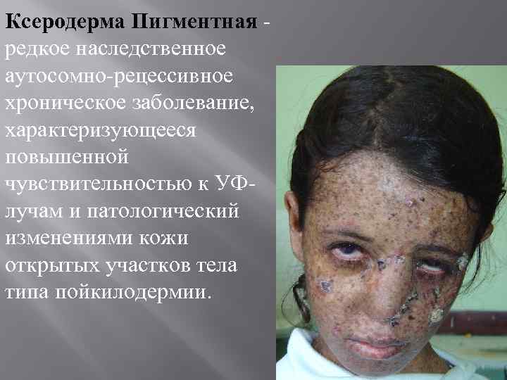 Ксеродерма Пигментная редкое наследственное аутосомно-рецессивное хроническое заболевание, характеризующееся повышенной чувствительностью к УФлучам и патологический