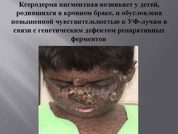 Ксеродерма пигментная возникает у детей, родившихся в кровном браке, и обусловлена повышенной чувствительностью к