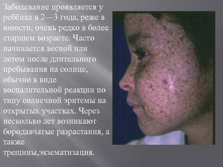 Заболевание проявляется у ребёнка в 2— 3 года, реже в юности, очень редко в