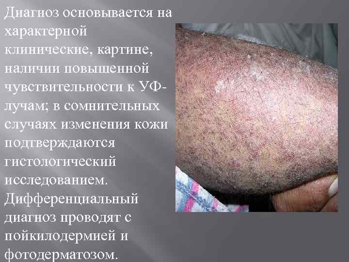 Диагноз основывается на характерной клинические, картине, наличии повышенной чувствительности к УФлучам; в сомнительных случаях