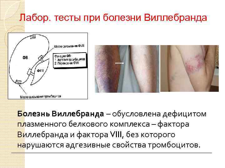 Лабор. тесты при болезни Виллебранда Болезнь Виллебранда – обусловлена дефицитом плазменного белкового комплекса –