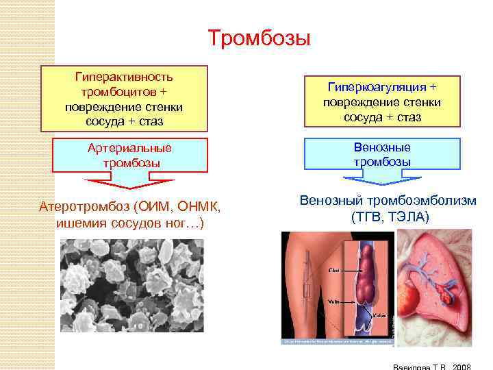 Тромбозы Гиперактивность тромбоцитов + повреждение стенки сосуда + стаз Артериальные тромбозы Атеротромбоз (ОИМ, ОНМК,