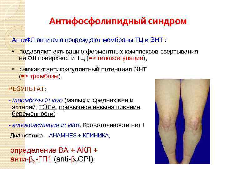 Антифосфолипидный синдром Анти. ФЛ антитела повреждают мембраны ТЦ и ЭНТ : • подавляют активацию