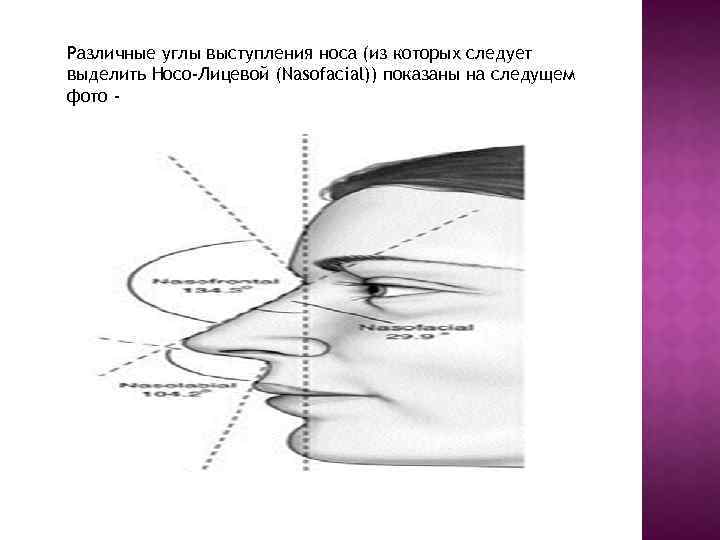 Различные углы выступления носа (из которых следует выделить Носо-Лицевой (Nasofacial)) показаны на следущем фото