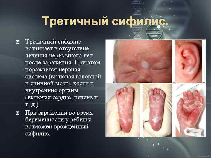 Третичный сифилис. Третичный сифилис возникает в отсутствие лечения через много лет после заражения. При
