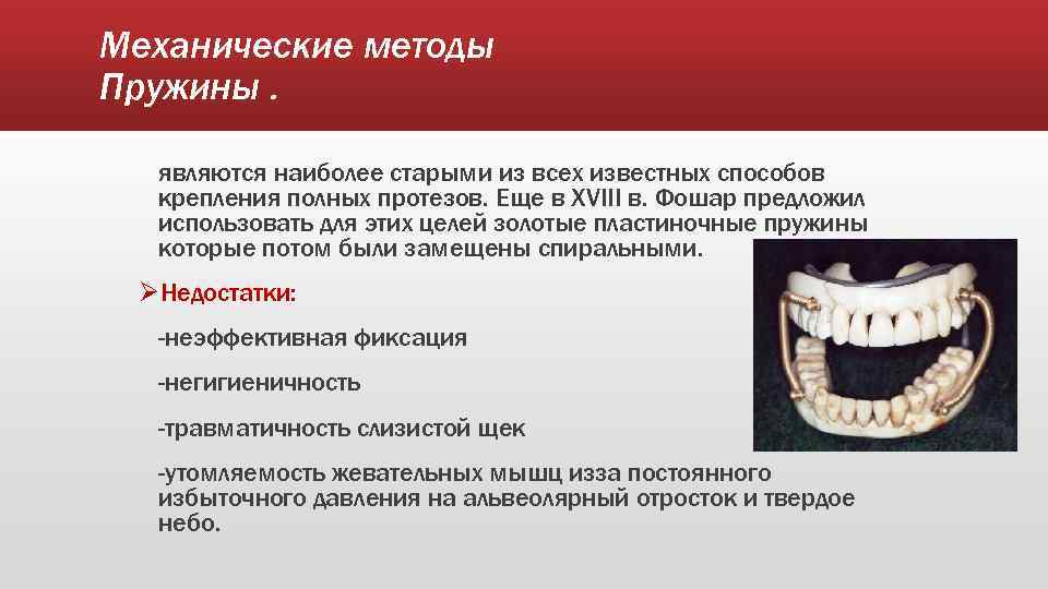 Механические методы Пружины. являются наиболее старыми из всех известных способов крепления полных протезов. Еще