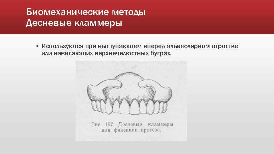 Биомеханические методы Десневые кламмеры ▪ Используются при выступающем вперед альвеолярном отростке или нависающих верхнечелюстных