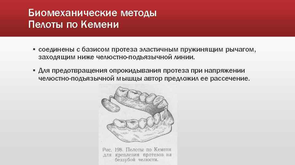 Биомеханические методы Пелоты по Кемени ▪ соединены с базисом протеза эластичным пружинящим рычагом, заходящим
