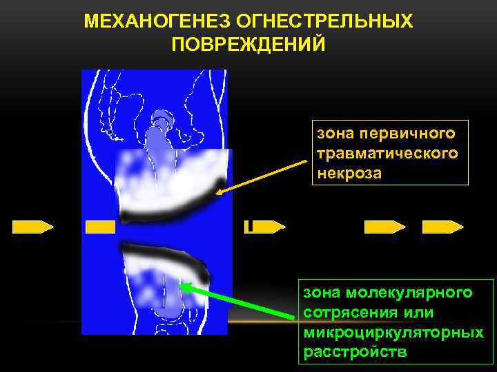 МЕХАНОГЕНЕЗ ОГНЕСТРЕЛЬНЫХ ПОВРЕЖДЕНИЙ зона первичного травматического некроза зона молекулярного сотрясения или микроциркуляторных расстройств 