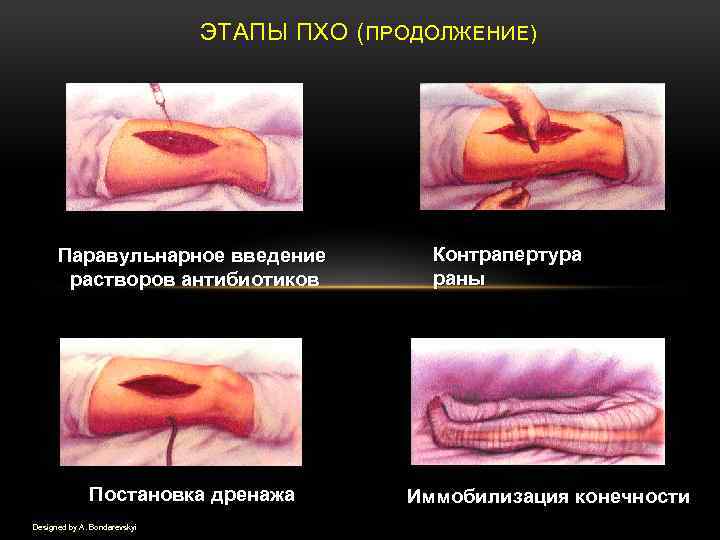 ЭТАПЫ ПХО (ПРОДОЛЖЕНИЕ) Паравульнарное введение растворов антибиотиков Постановка дренажа Designed by A. Bondarevskyi Контрапертура