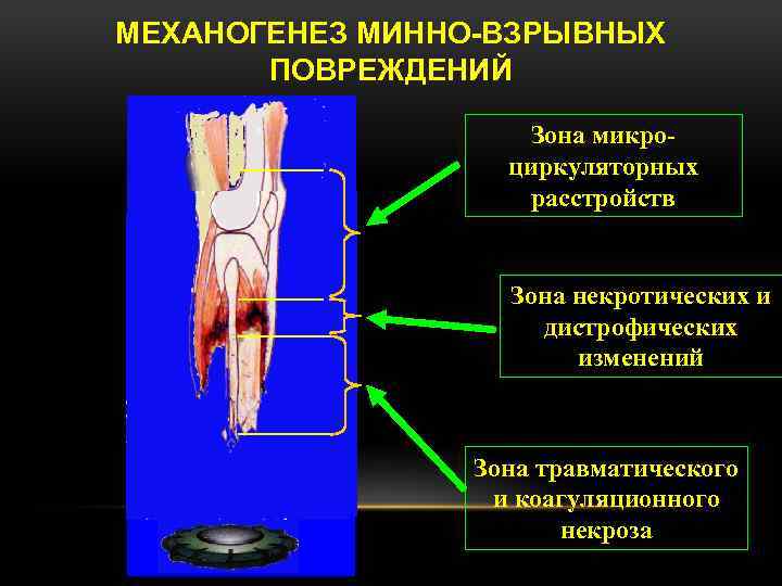 МЕХАНОГЕНЕЗ МИННО-ВЗРЫВНЫХ ПОВРЕЖДЕНИЙ Зона микроциркуляторных расстройств Зона некротических и дистрофических изменений Зона травматического и