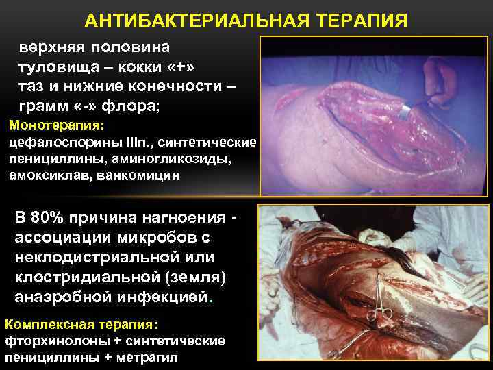 АНТИБАКТЕРИАЛЬНАЯ ТЕРАПИЯ верхняя половина туловища – кокки «+» таз и нижние конечности – грамм