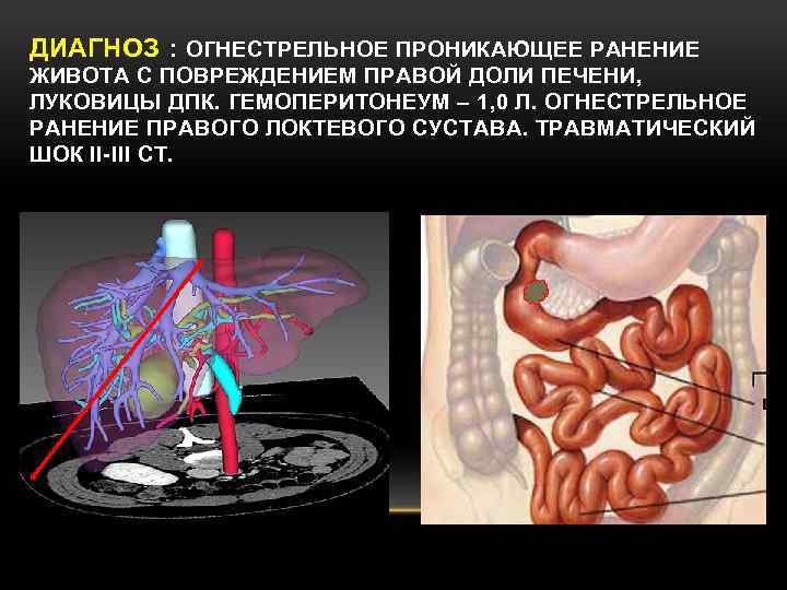 ДИАГНОЗ : ОГНЕСТРЕЛЬНОЕ ПРОНИКАЮЩЕЕ РАНЕНИЕ ЖИВОТА С ПОВРЕЖДЕНИЕМ ПРАВОЙ ДОЛИ ПЕЧЕНИ, ЛУКОВИЦЫ ДПК. ГЕМОПЕРИТОНЕУМ