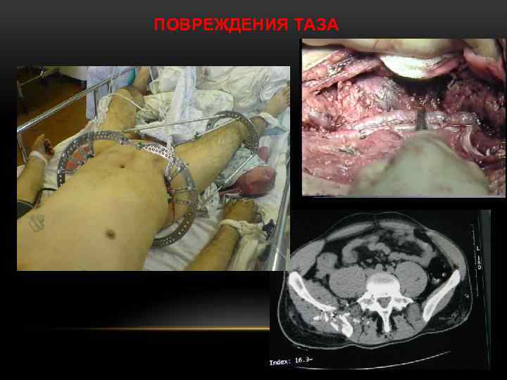 ПОВРЕЖДЕНИЯ ТАЗА 