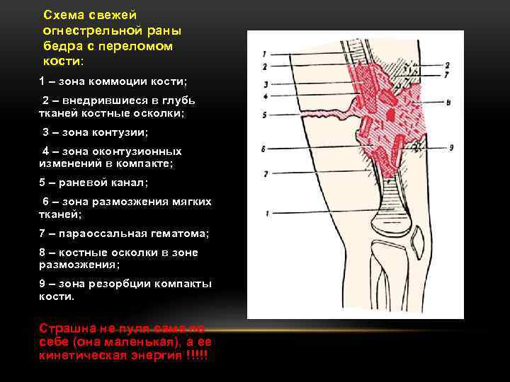 Схема свежей огнестрельной раны бедра с переломом кости: 1 – зона коммоции кости; 2