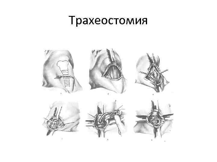 Трахеостомия техника выполнения в картинках для детей