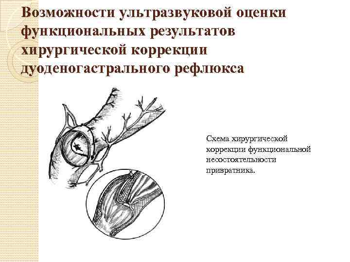 Возможности ультразвуковой оценки функциональных результатов хирургической коррекции дуоденогастрального рефлюкса Схема хирургической коррекции функциональной несостоятельности