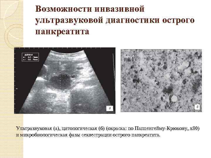 Возможности инвазивной ультразвуковой диагностики острого панкреатита Ультразвуковая (а), цитологическая (б) (окраска: по Паппенгейму Крюкову,