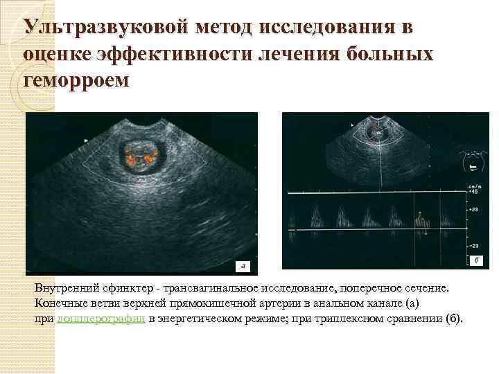 Ультразвуковой метод исследования в оценке эффективности лечения больных геморроем Внутренний сфинктер трансвагинальное исследование, поперечное