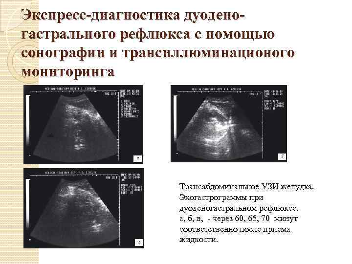 Экспресс-диагностика дуоденогастрального рефлюкса с помощью сонографии и трансиллюминационого мониторинга Трансабдоминальное УЗИ желудка. Эхогастрограммы при