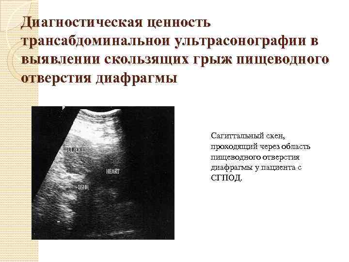 Диагностическая ценность трансабдоминальнои ультрасонографии в выявлении скользящих грыж пищеводного отверстия диафрагмы Сагиттальный скен, проходящий