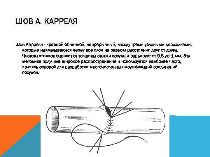 ШОВ А. КАРРЕЛЯ Шов Карреля - краевой обвивной, непрерывный, между тремя узловыми держалками, которые