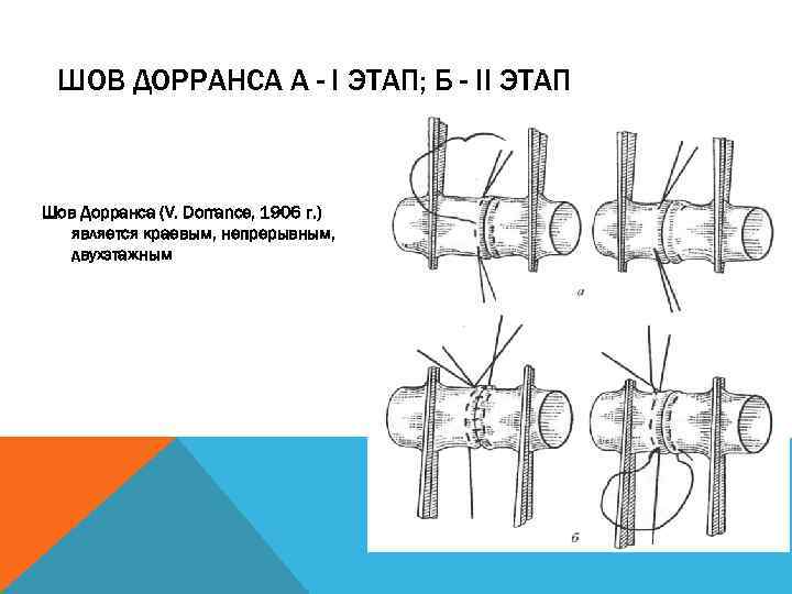 ШОВ ДОРРАНСА А - I ЭТАП; Б - II ЭТАП Шов Дорранса (V. Dorrance,