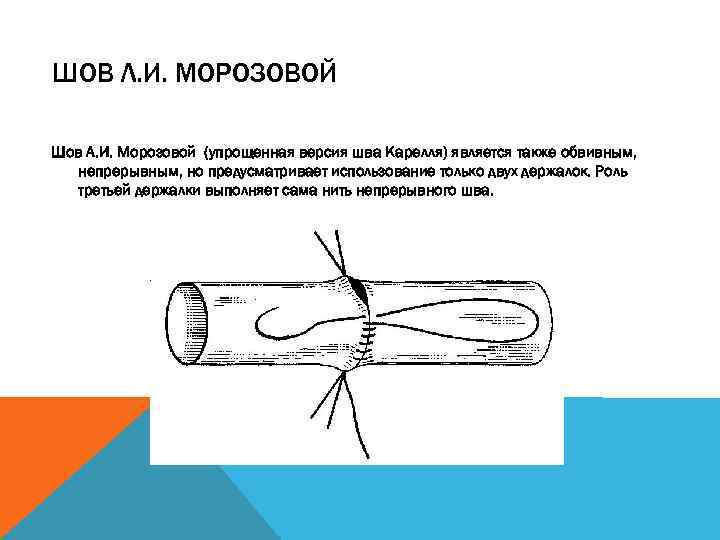 ШОВ Л. И. МОРОЗОВОЙ Шов А. И. Морозовой (упрощенная версия шва Карелля) является также