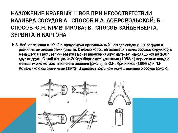 НАЛОЖЕНИЕ КРАЕВЫХ ШВОВ ПРИ НЕСООТВЕТСТВИИ КАЛИБРА СОСУДОВ А - СПОСОБ Н. А. ДОБРОВОЛЬСКОЙ; Б